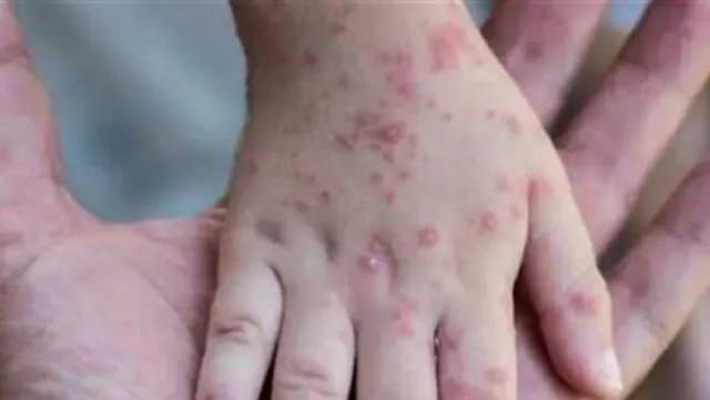 'Monkey Pox' riot in Vijayawada