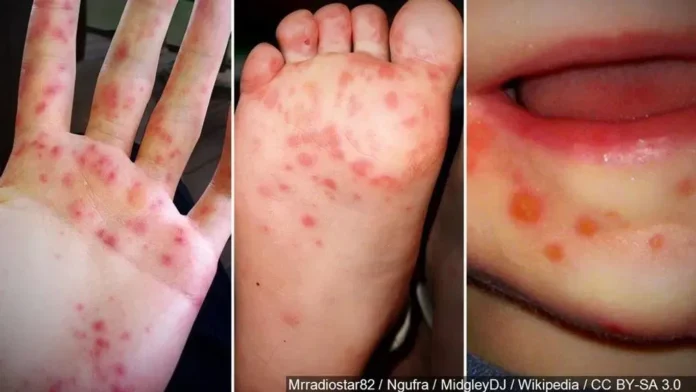 Hand foot and mouth disease in AP